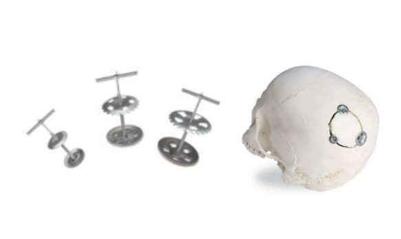 Fijadores de colgajo óseo del sistema Lorenz Plating System Neuro